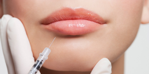 LIPPENFORMUNG MIT HYALURONSÄURE
